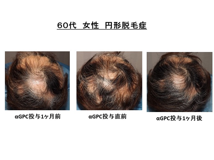 円形脱毛症　病院